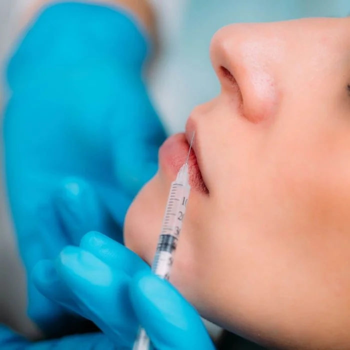 dermal-filler-for-lips-2022-02-08-02-04-42-utc2 (1)