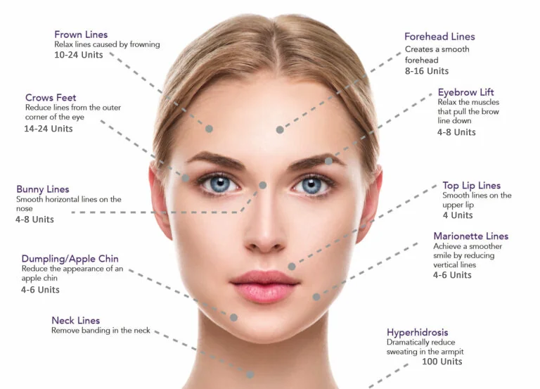 Botox-Areas-Lower-Hutt
